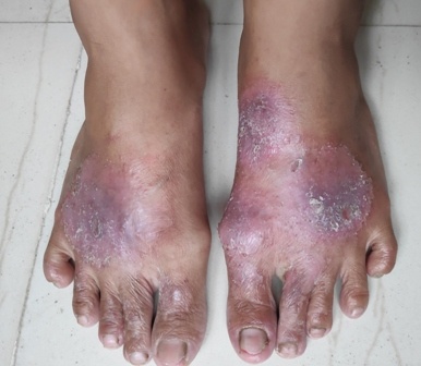 Eczema involving dorsum of both feet