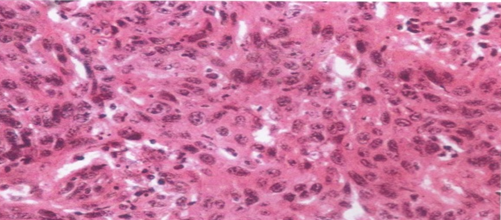 Moderately differentiated squamous cell carcinoma of tongue (H&E, 400x)