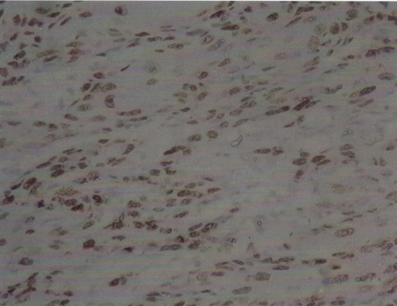 p53 immunopositivity in a case of squamous cell carcinoma of buccal mucosa with lymph node matastasis (400x)