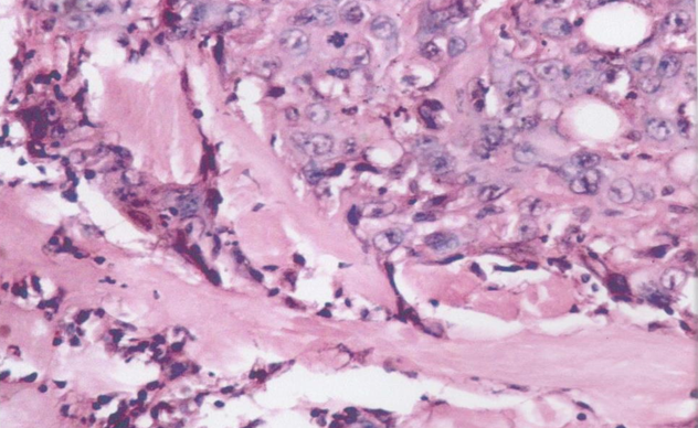 Muscle invasion in a case of squamous cell carcinoma of buccal muscosa (H&E, 400x)