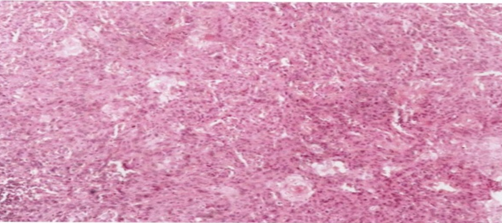 Moderately differentiated squamous cell carcinoma of tongue (H&E, 100x)