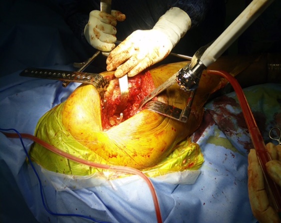 Complete acetabular exposure