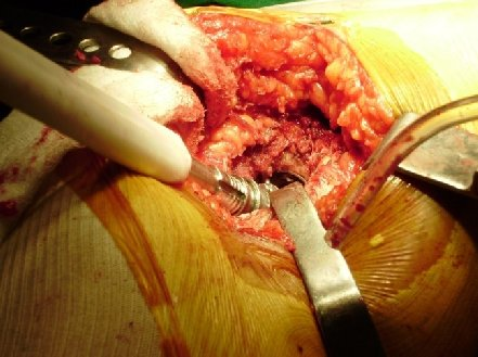 Acetabular reaming