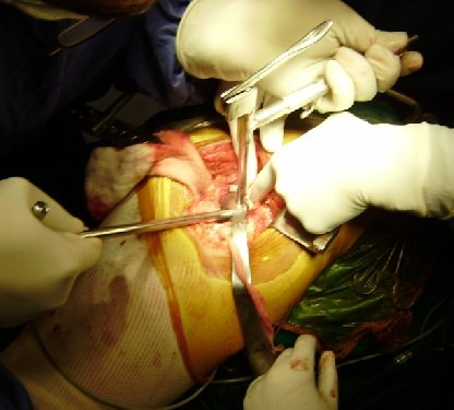 Placing trial acetabular cup