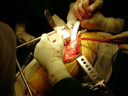 Femoral canal preparation