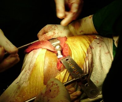 Trial femoral stem in situ and trial reduction
