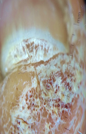 Showing dilated hyponychial vessels
