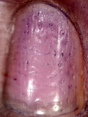 Showing nail pitting through dermatoscope as stained with Giemsa stain