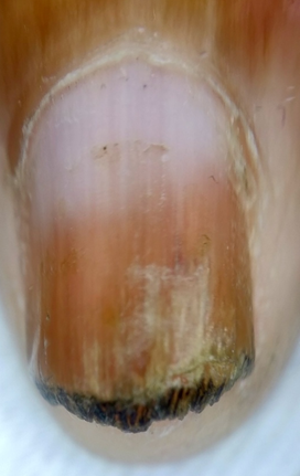 Showing nail plate thickening