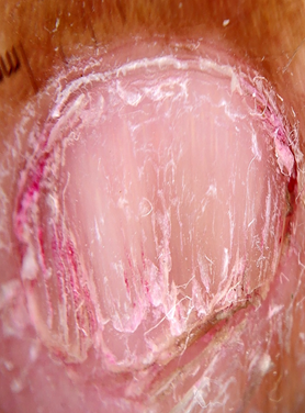 Showing longitudinal ridging