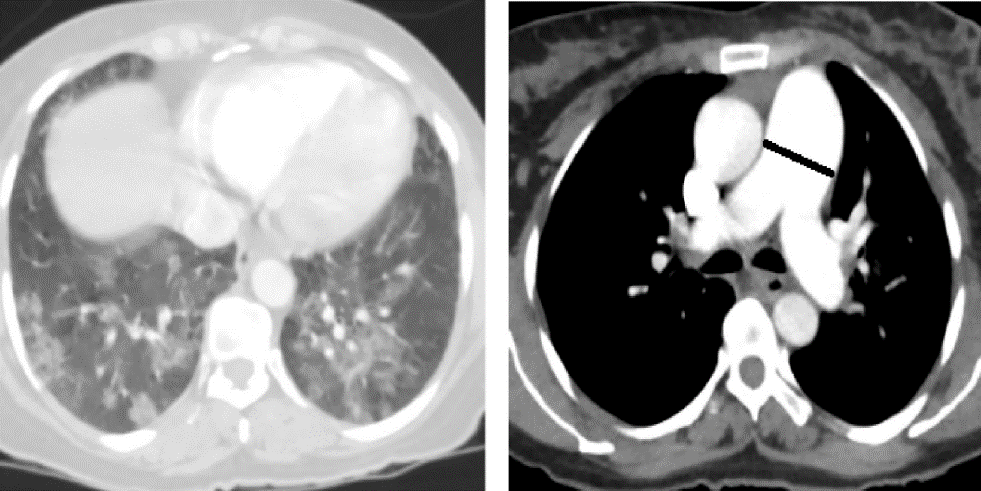 CT pulmonary angiography (CTPA)- dilated main pulmonary artery (diameter of 3.41cm), bilateral diffuse mosaic pattern and consolidation predominantly in lower lobes