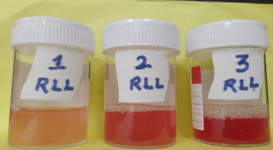 Bronchoscopy guidedbronchoalveolar lavage (BAL) from right lower lobe (RLL) showed sequentially increasing hemorrhagic lavage.
