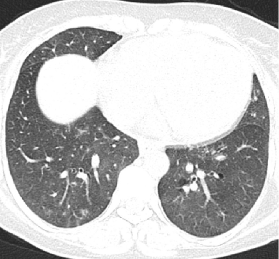 HRCT thorax showing near total resolution radiological opacities.