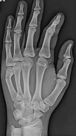 Pre-operative radiograph of an Extra-articular fracture of the neck of the 5 th metacarpal