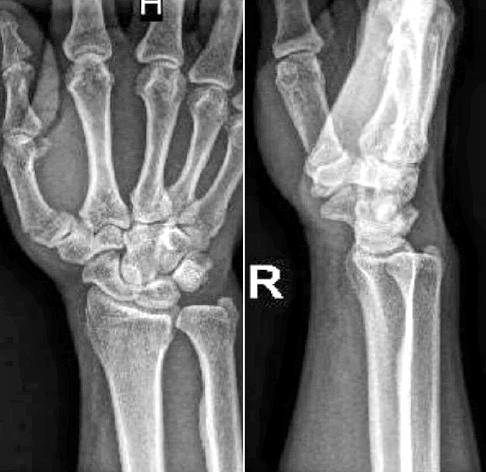 Pre-operative radiograph of an Extra-articular fracture of the base of the Thumb