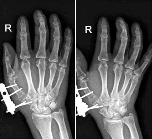 Post-operative radiograph of fracture of the base of the thumb treated with JESS