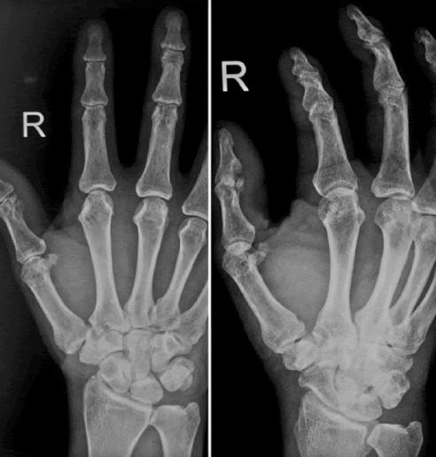 Radiographic picture of patient treated with JESS at follow up at 10 weeks