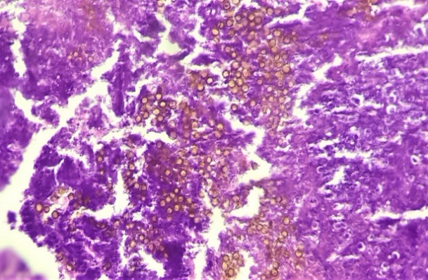 H&E stain show sclerotic “ copper-pennies ” appearance - pathognomonic of chromoblastomycosis (x20)