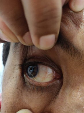 Showing graft oautologous serum – good acceptance of graft
