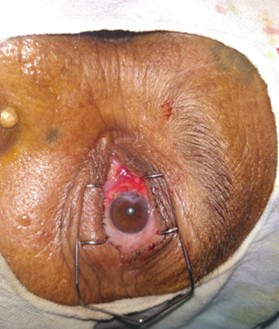 Showing advancement flap with suture.
