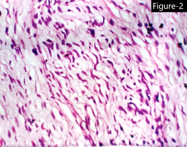 Histopathological findings of case 1- The stroma showes wire-like strands of collagen (shredded carrot), areas of myxoid changes and vascular proliferation and adipose tissue intermingled with tumour cells