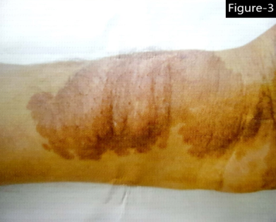 Single, large, soft, elongated, non-tender swelling of size 10*5 cm over a pre-existing café-au- lait spot on ventral aspect of left forearm near the wrist