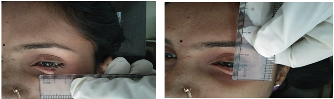 Measuring the size (mm) of chalazion.
