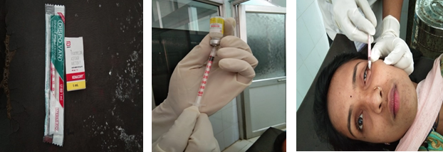 Material required and technique of giving intralesional triamcinolone acetonide injection.