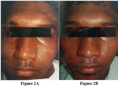 A,B: Shows Before and After Treatment (at 12 weeks) with Adapalene 0.1% respectively