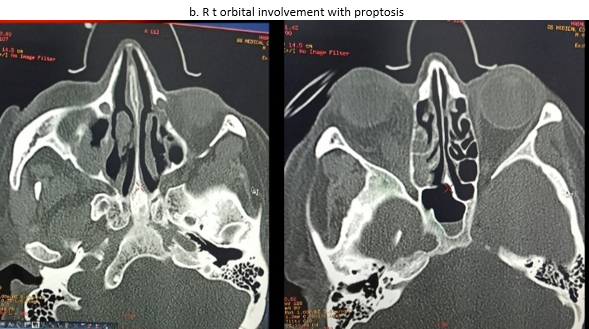 Computerised tomography. a. Rt maxillary sinus non-hemogenous opacification