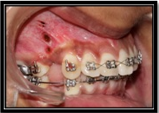 Microosteo perforations