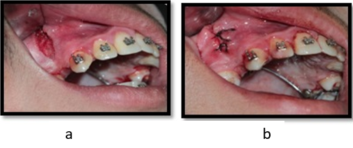 a, b- Corticision