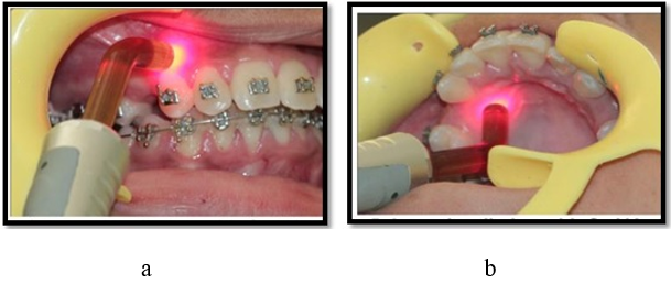 a, b- Low level laser therapy
