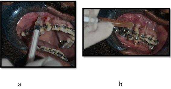 a,b- Platelet rich plasma