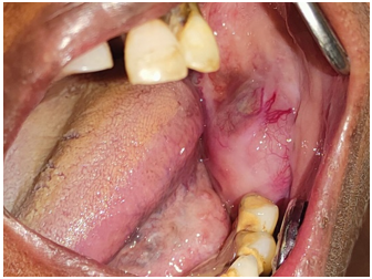 Intraoral image shows h ard, tender swelling, approximately 3 by 4 cm, extended from the second premolar, involving the ramus and mandibular body. Dilated vessels covered its surface with obliteration of the buccal vestibule.