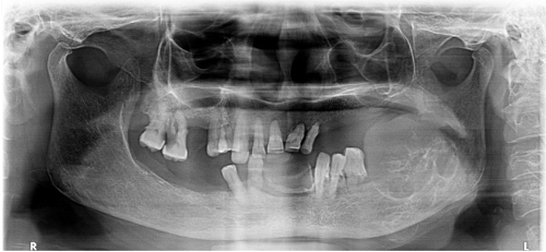 Panoramic radiograph depictsirregular, lobulated, expansile osteolytic lesion, approximately 3*4cm in size, extending from the distal aspect of the 2nd premolar to the ramus and coronoid process posteriorly.