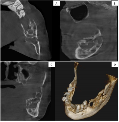 Cone beam computed tomography (CBCT) sections shows a single, well-defined hypodense lesion with septations is seen on the left side of the mandibular body and ramus extending from the area of tooth 36 to the ascending ramus, resulting in expansion and thinning of the lingual and buccal cortical plates. (A) Axial (B) Sagittal (C)Coronal D) 3D CBCT.