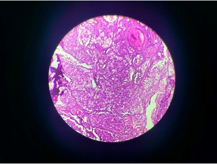 Given H/E-stained section showed glandular component with severe dysplastic changes along with disruption of septate and mucoid content in some ducts. Background also shows presence of epidermoid cells, intermediate cells, and mucous cells with areas of degenerated bony trabeculae.