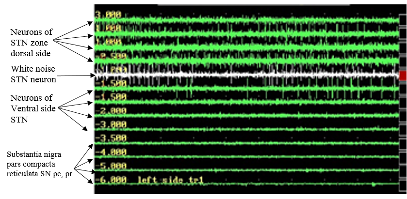 microelectrode signal recordings of sub thalamic nucleus neurons
