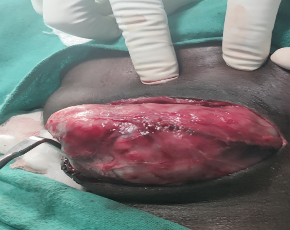Intraoperative picture of huge submandibular mass on left side