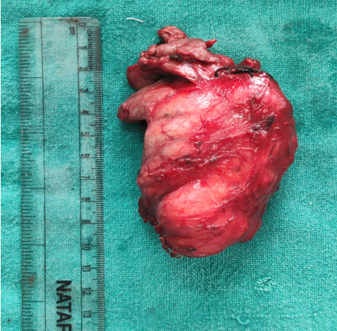 Gross specimen of the excised tumour
