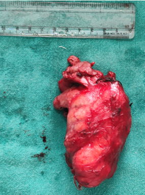 Gross specimen of the excised tumour