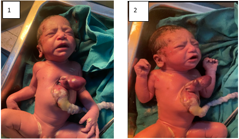 Showed 1) Ectopia cordis and 2) Supraumbilical omphalocele.
