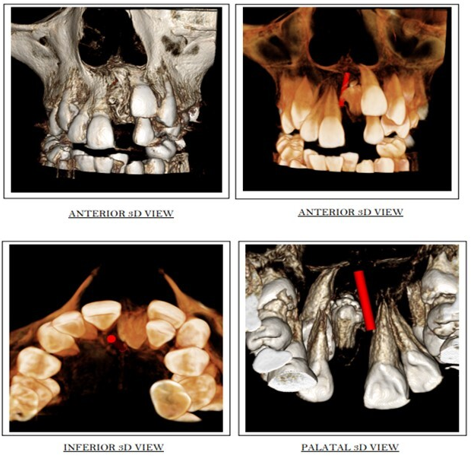 CBCT images of anterior maxilla