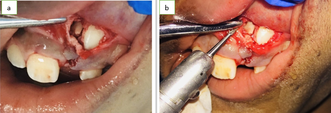 a,b: During the procedure (Elevation of flap and guttering of bone)