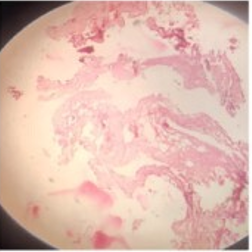 Histopathological section of specimen showing irregular arrangement of fibers with focal area of hyalinization and a few calcified masses