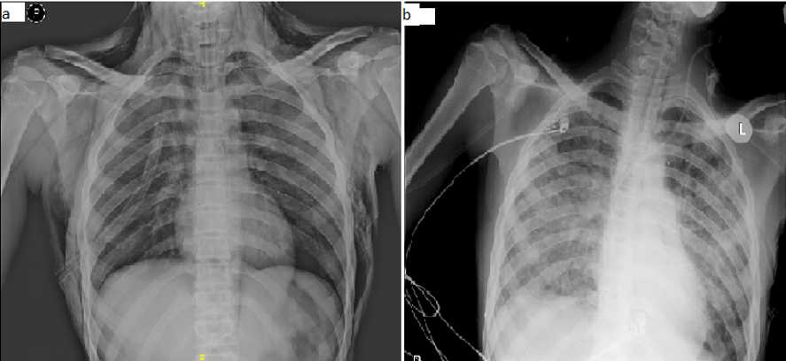 a: Chest X-ray antero-posterior view showed bilateral subcutaneous emphysema with pneumomediastinum; b: Chest X-ray showed resolution of subcutaneous emphysema with bilateral non homogenous opacity.