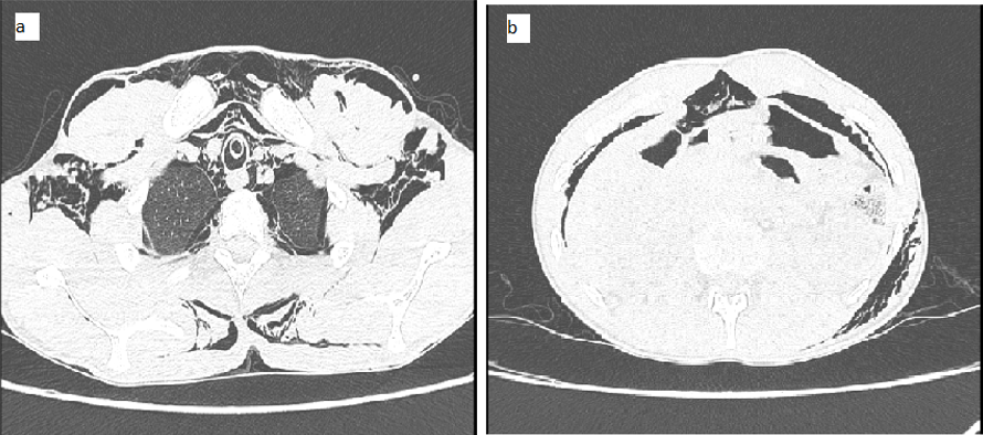 a: High-Resolution Computed tomography (HRCT) Thorax showed gross subcutaneous emphysema with pneumomediastinum with bilateral pneumothorax; b: Computed tomography abdomen showed in subdiaphragmatic air collection suggestive of pneumoperitoneum.