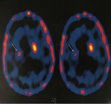 DOPA PET scan showing hypometabolism in right putamen