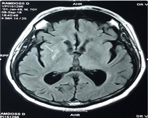 MRI Brain FLAIR sequence showing hyperintensity in the right putamen (white arrow)